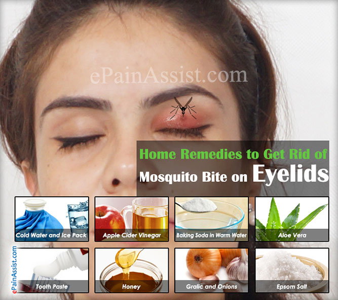 Home Remedies To Get Rid Of Mosquito Bite On Eyelid