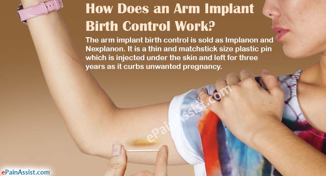 How does Arm Implant Birth Control Work