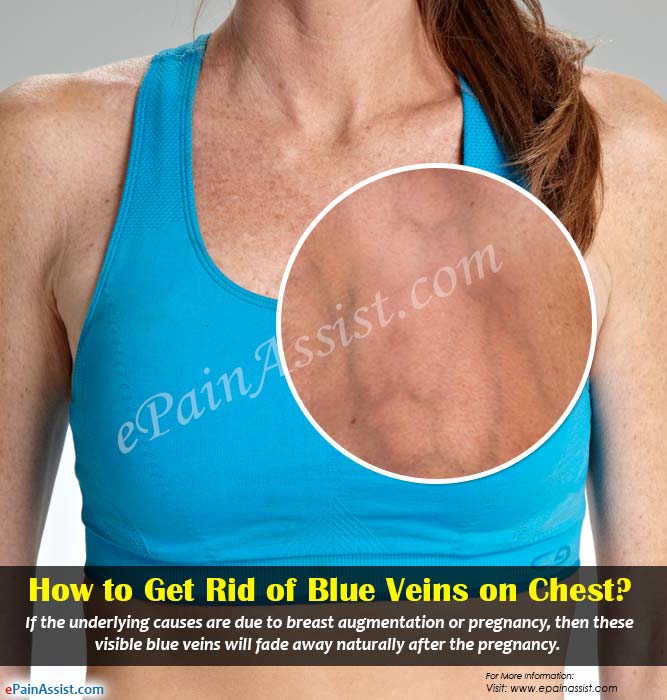 How To Get Rid Of Blue Veins On Chest