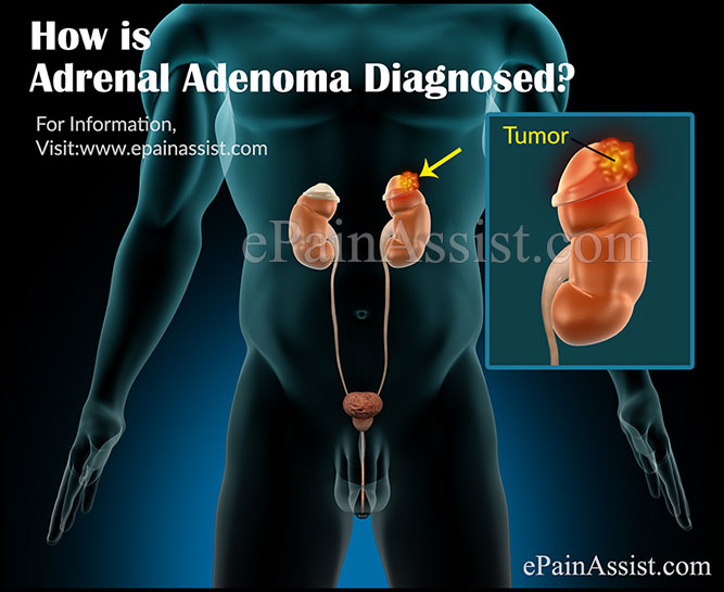 How is Adrenal Adenoma Diagnosed?