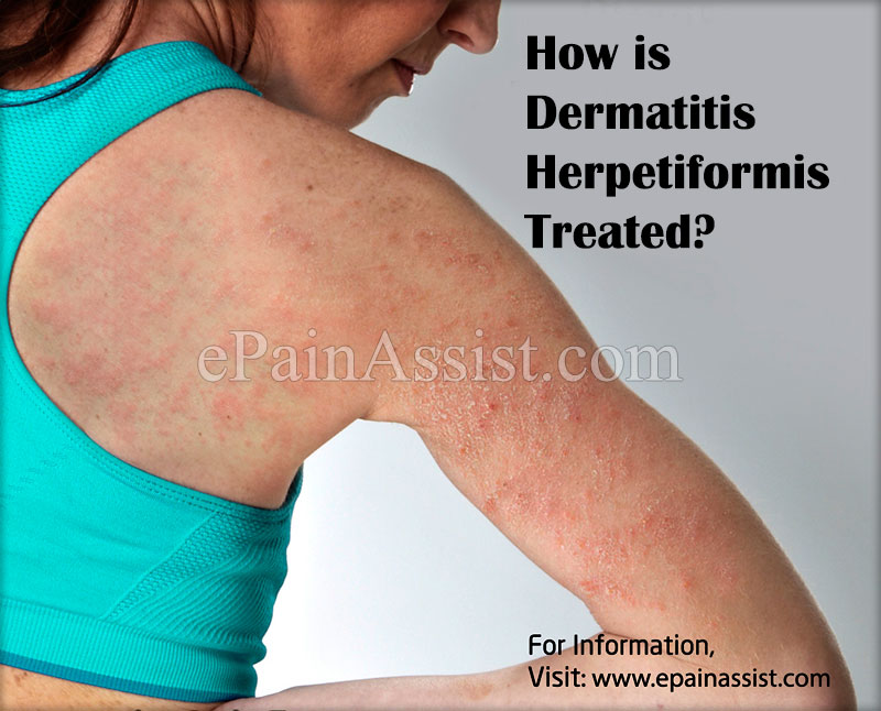 Dermatitis Herpetiformis Treatment SQPSFS