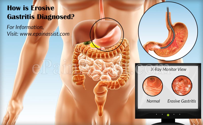 How is Erosive Gastritis Diagnosed?