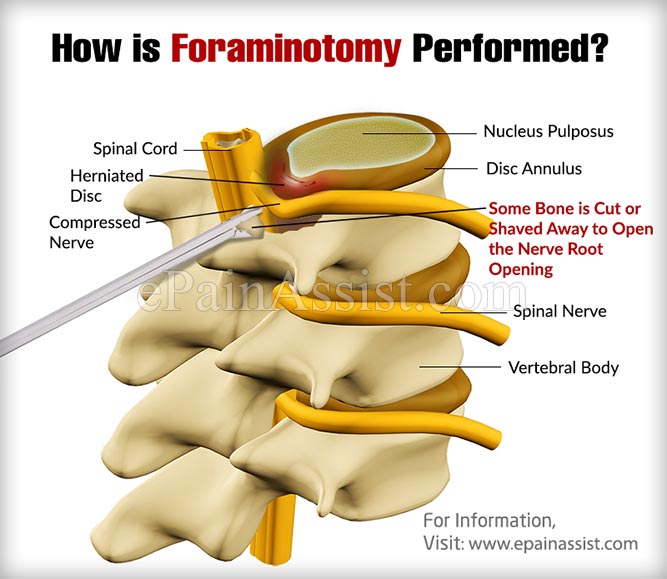 Why is Foraminotomy Procedure Performed?