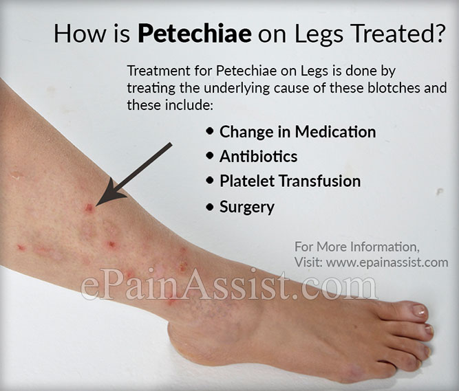 How is Petechiae on Legs Treated?