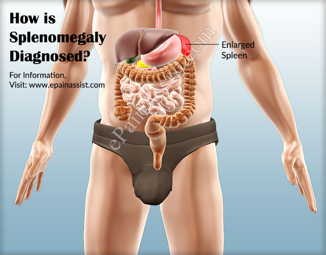 How is Splenomegaly Diagnosed?