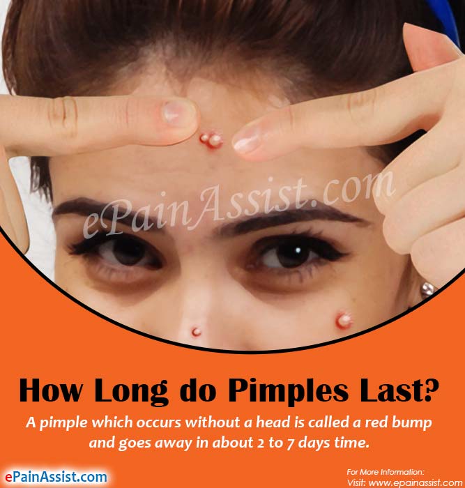 How Long do Pimples Last &amp; Ways to Get Rid of it Fast?