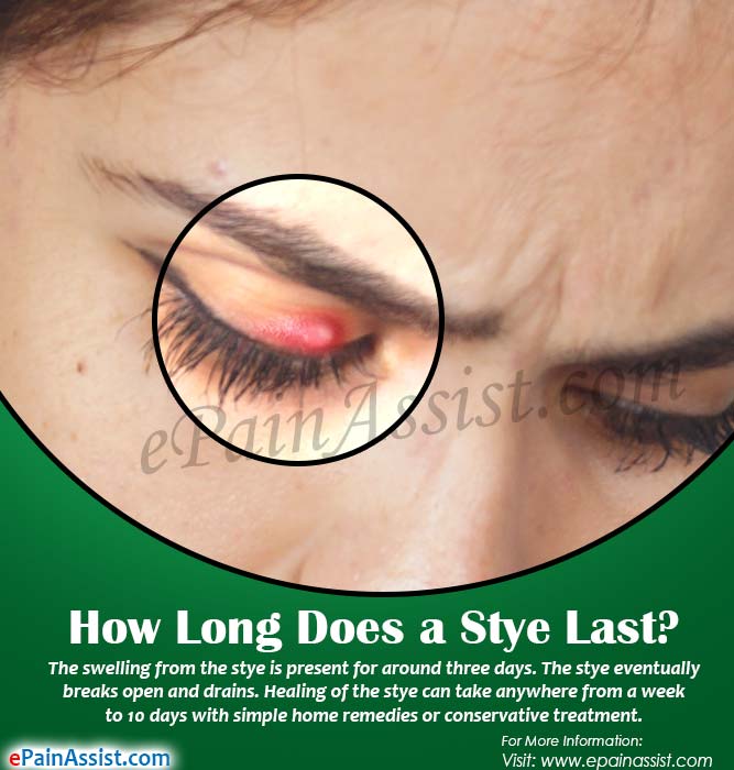 How Long Does a Stye Last?