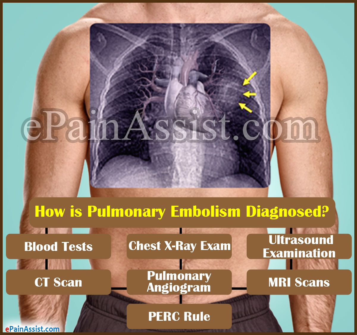 How is Pulmonary Embolism Diagnosed