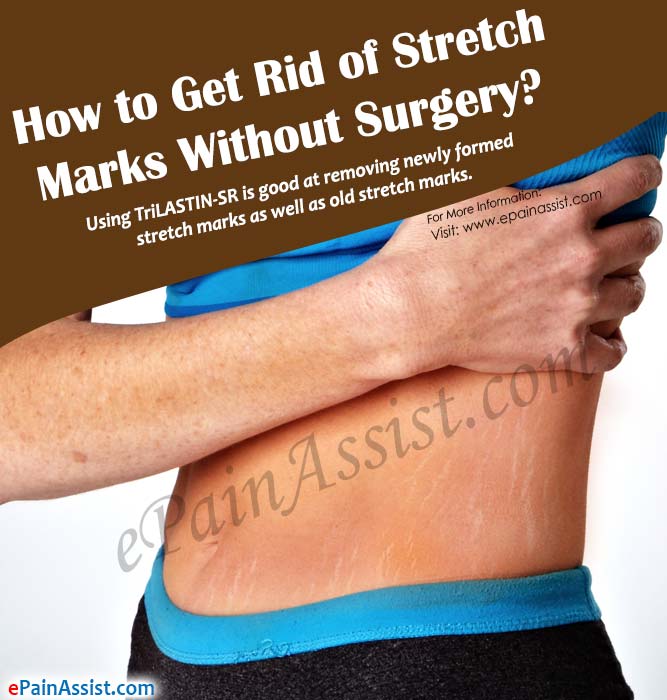 How to Get Rid of Stretch Marks Without Surgery?