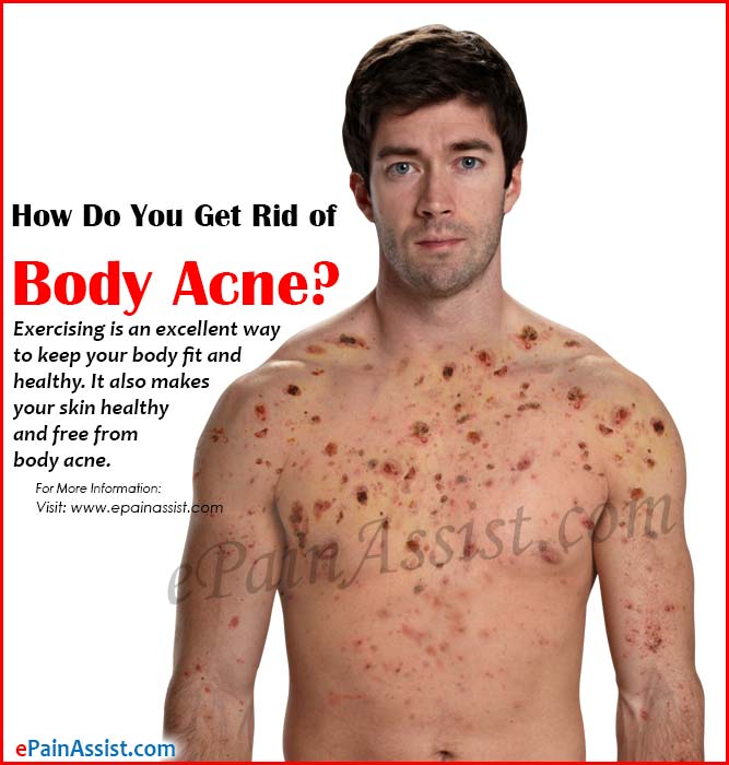 How Do You Get Rid of Body Acne?