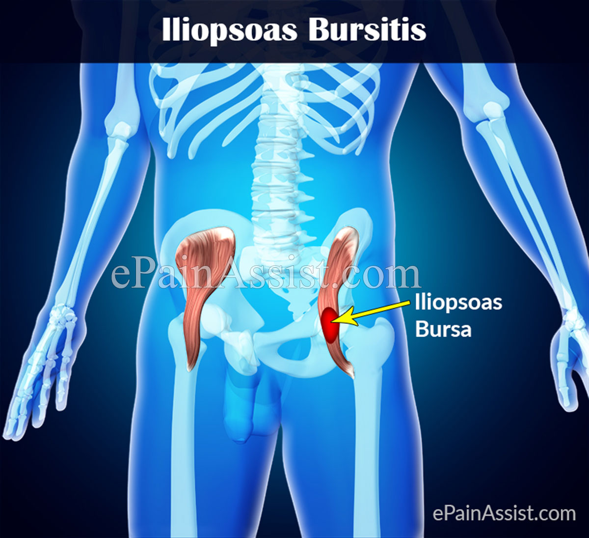 Iliopsoas Bursitis or Iliopectineal Bursitis