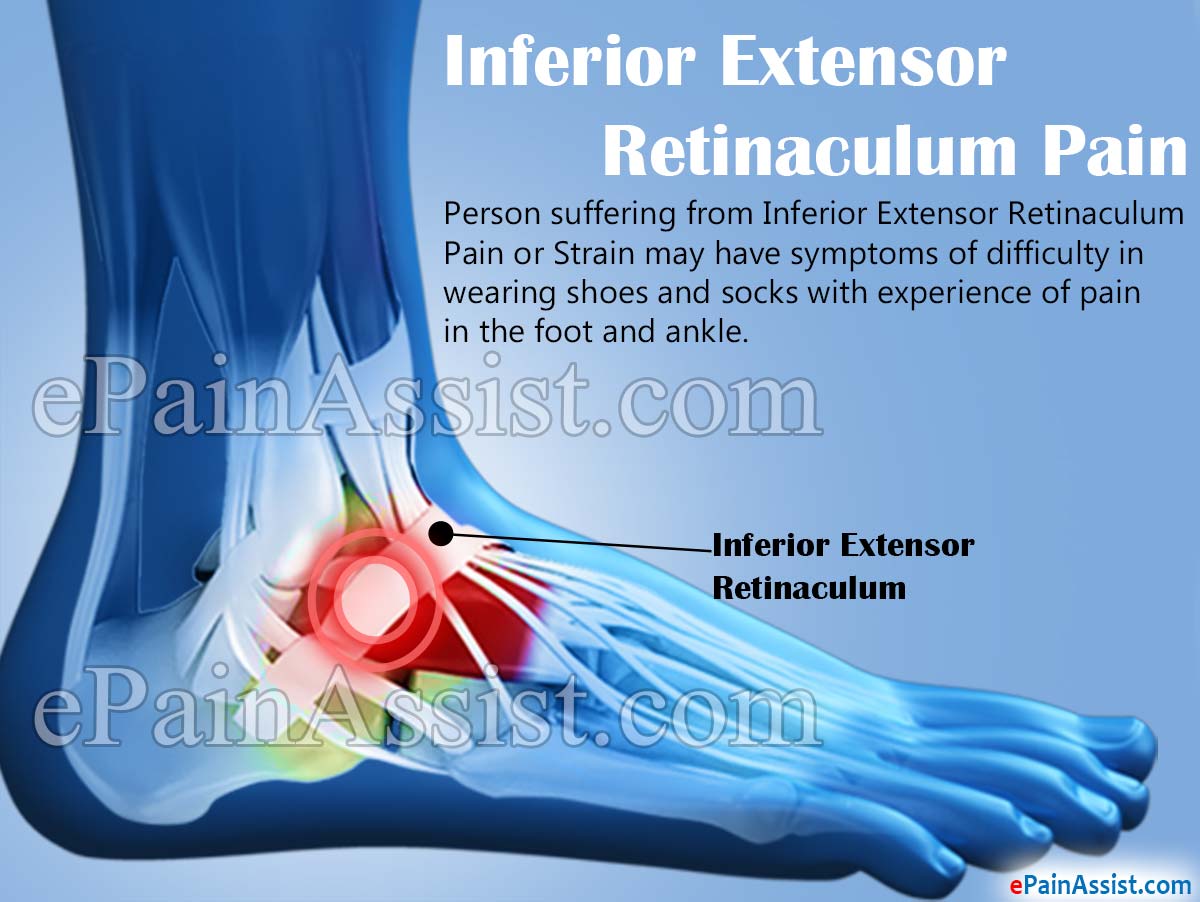 Inferior Extensor Retinaculum Pain