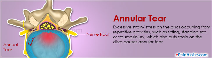 Annular Tear