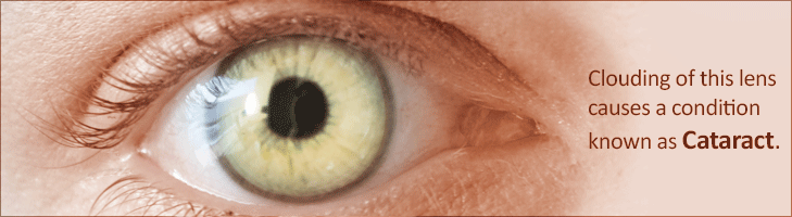 Cataracts Types Causes Signs Tests Treatment Surgery Home Remedies 