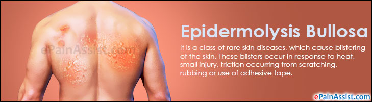 Epidermolysis Bullosa Treatment, Home Remedies, Lifestyle