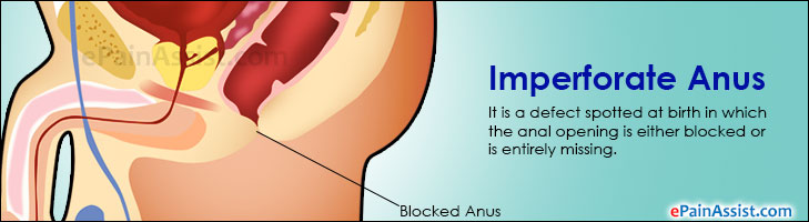 Anal Malformation 33