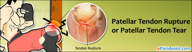 Patellar Tendon RuptureTreatmentRecoveryPrognosisCauses