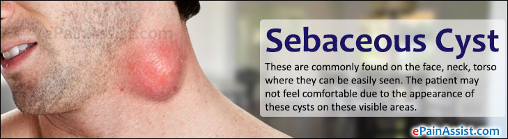 Sebaceous Cyst