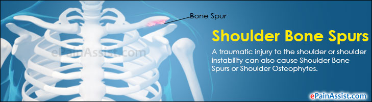 Shoulder Bone Spurs Treatment Symptoms Causes Diagnosis