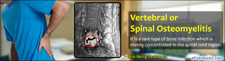 Vertebral or Spinal Osteomyelitis|Causes|Symptoms|Treatment-Nonsurgical