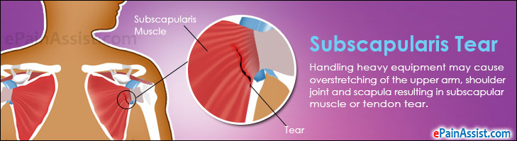 Subscapularis Tear Treatment Causes Symptoms Signs