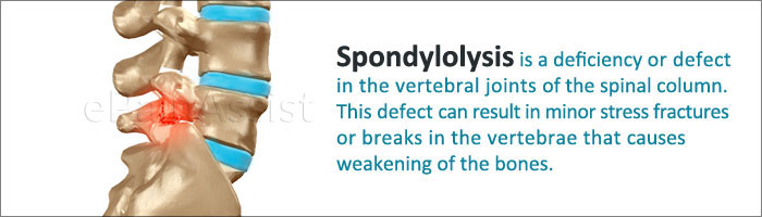 Spondylolysis treatment image