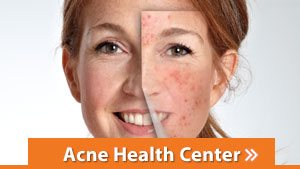 Acne Health