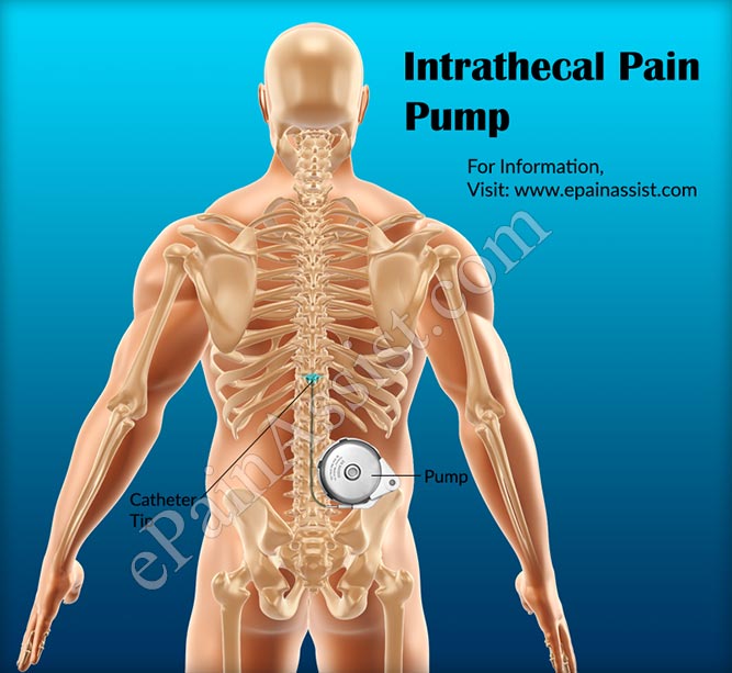 Intrathecal Pain Pump: Cost of Surgery and Refill