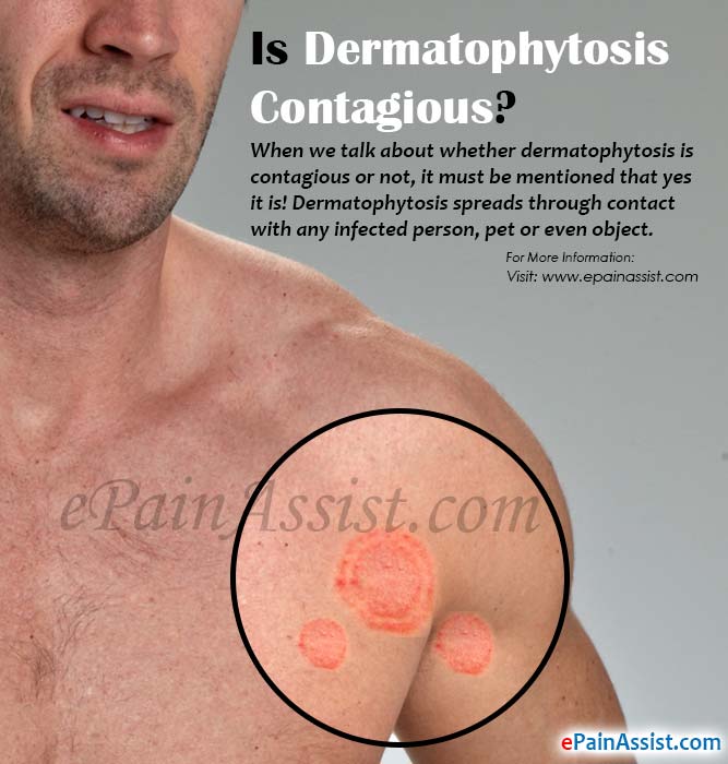 Is Dermatophytosis Contagious?