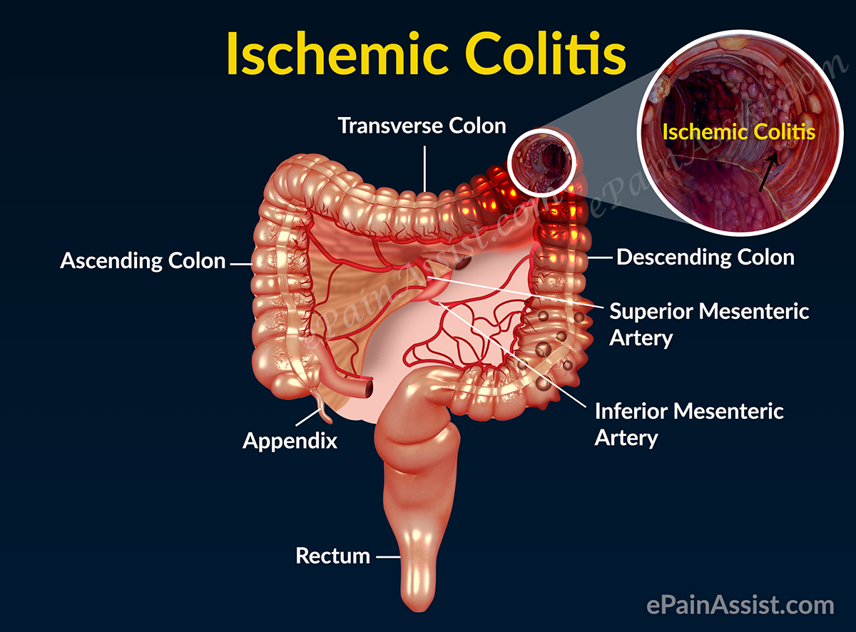 What are the symptoms of colitis?