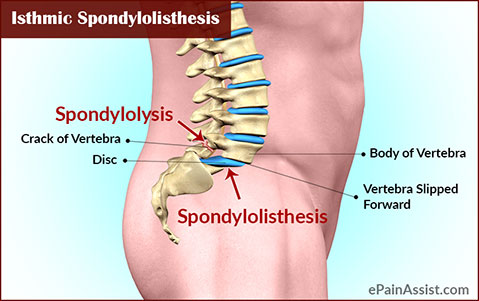 What is Isthmic Spondylolisthesis?