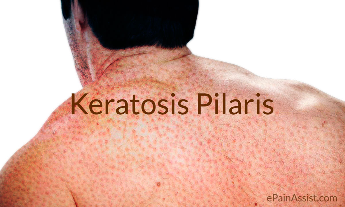 Keratosis Pilaris (KP) Keratosis Pilaris (KP)