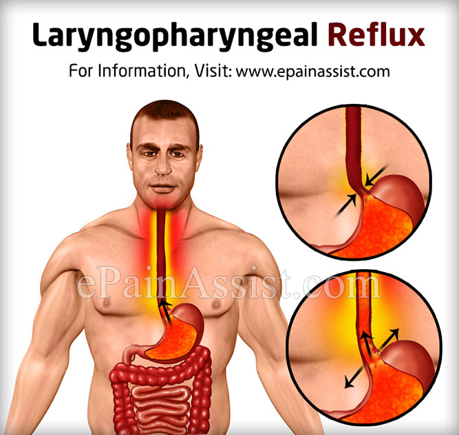 Silent Reflux Or Laryngopharyngeal Reflux Causes Treatment Home 