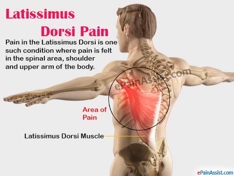 Latissimus Dorsi Pain Latissimus Dorsi Pain