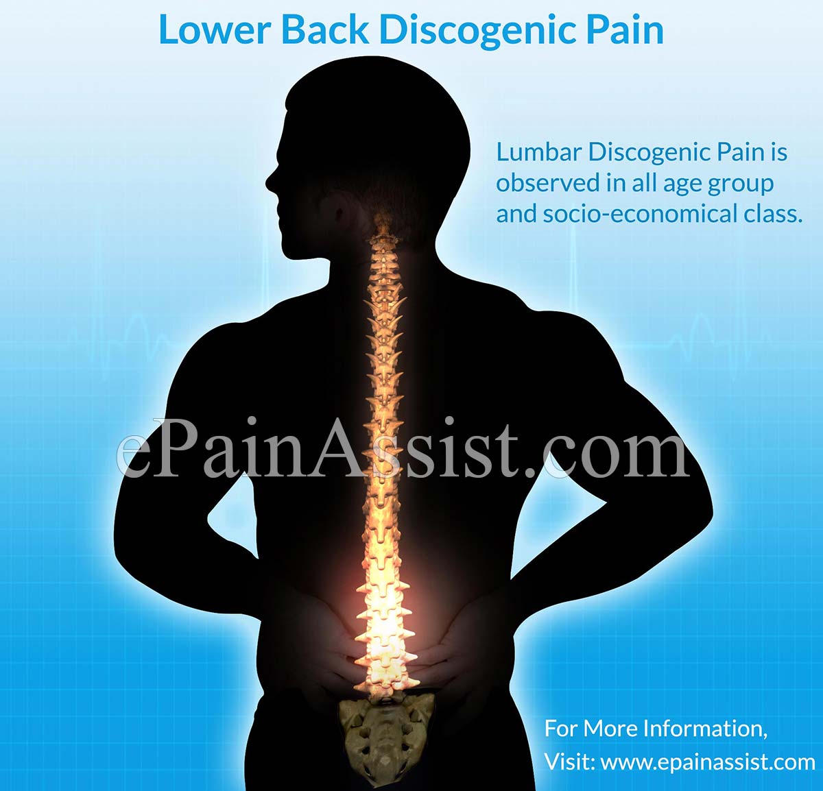 Lower Back Discogenic Pain or Lumbar Discogenic Pain