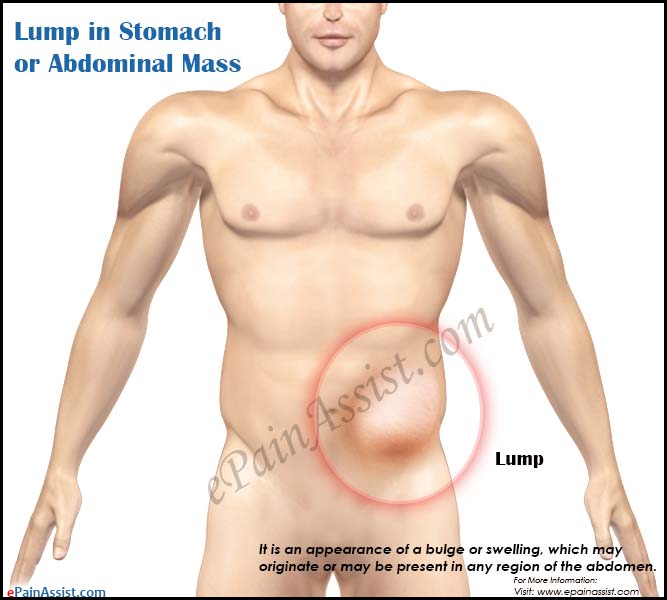 Lump in Stomach or Abdominal Mass