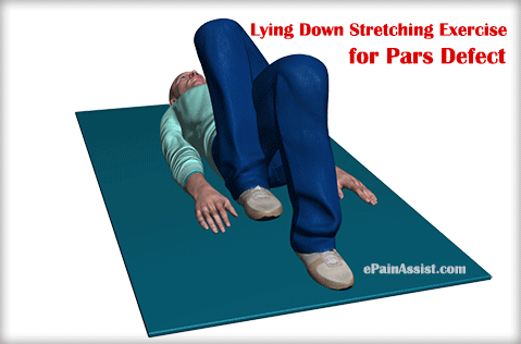 Pars Defect|Causes|Symptoms|Treatment|Exercise|Diagnosis|Prevention