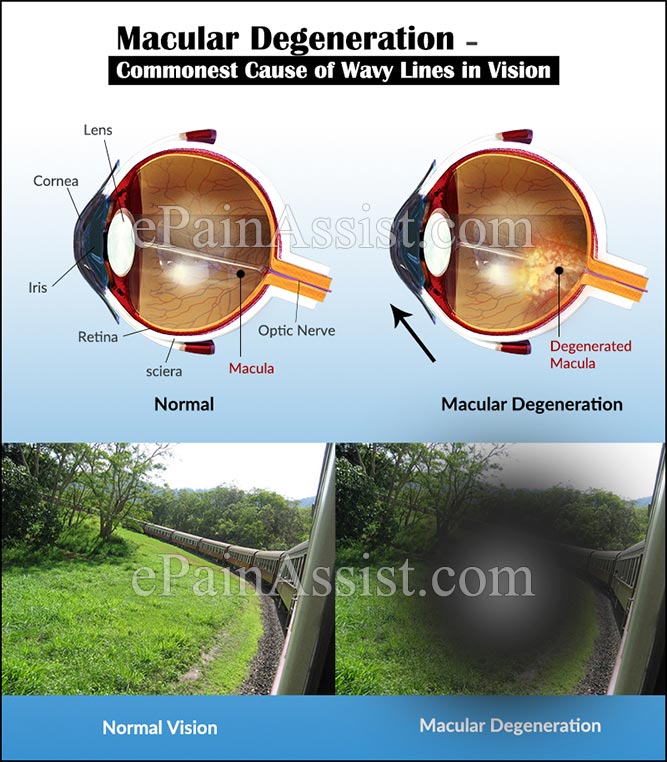 Macular Degeneration – Commonest Cause of Wavy Lines in Vision