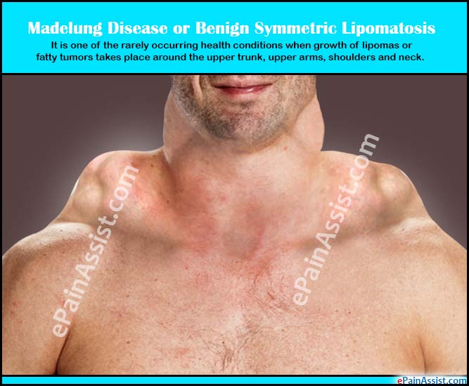 Madelung Disease or Benign Symmetric Lipomatosis Madelung Disease or Benign Symmetric Lipomatosis