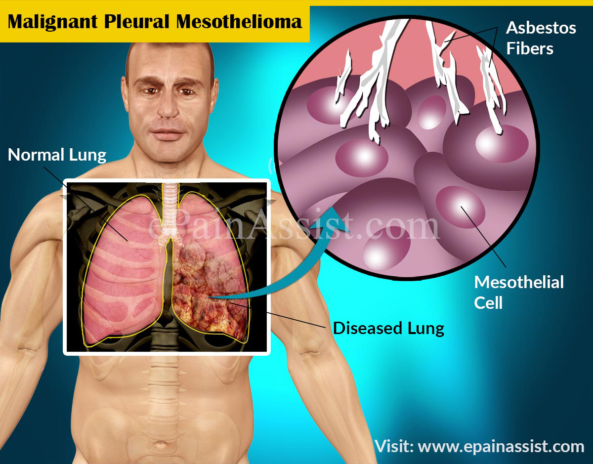 Risk Factors for Malignant Pleural Mesothelioma