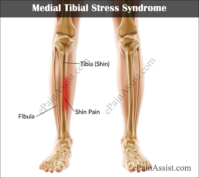 Medial Tibial Stress Syndrome or Shin Splints