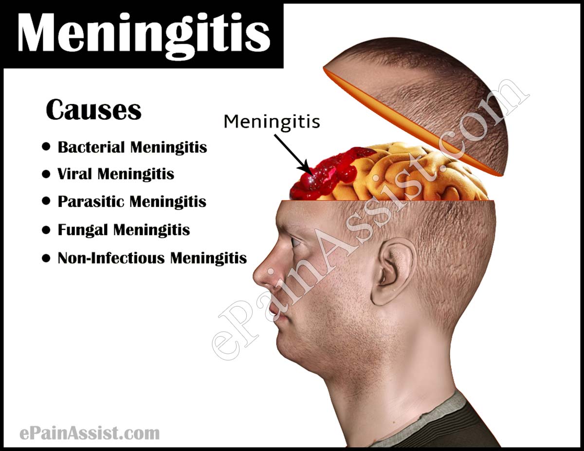 Meningitis: Causes, Types, Risk Factors, Clinical Features, Diagnosis, Treatment, Prevention, Vaccines