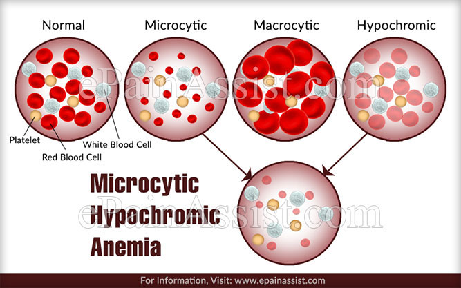 Normochromic Vs Hypochromic Microcytic Anemia Causes Symptoms And 