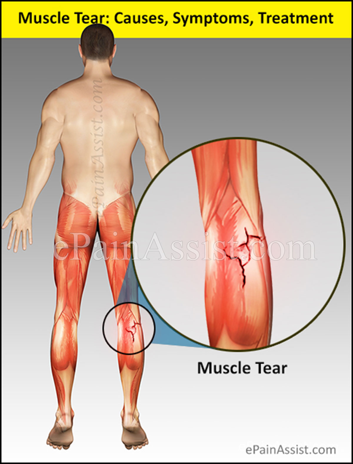 Muscle Tear: Causes, Symptoms, Treatment