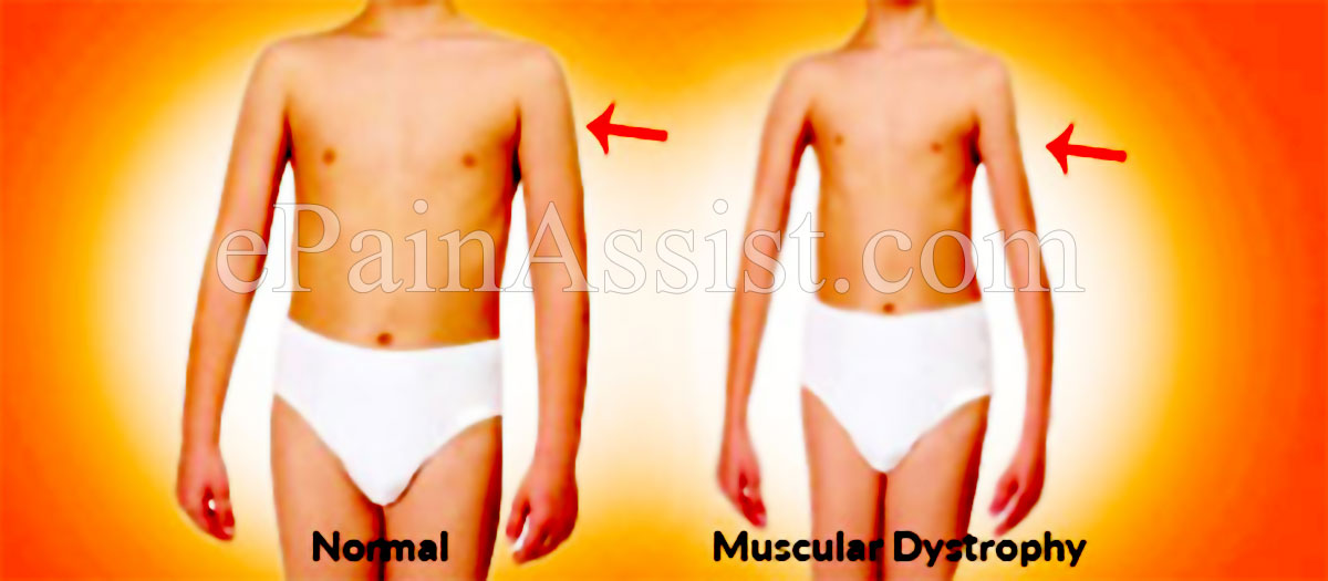 Duchenne's Muscular Dystrophy (DMD) or Muscular Dystrophy Duchenne's Muscular Dystrophy (DMD) or Muscular Dystrophy