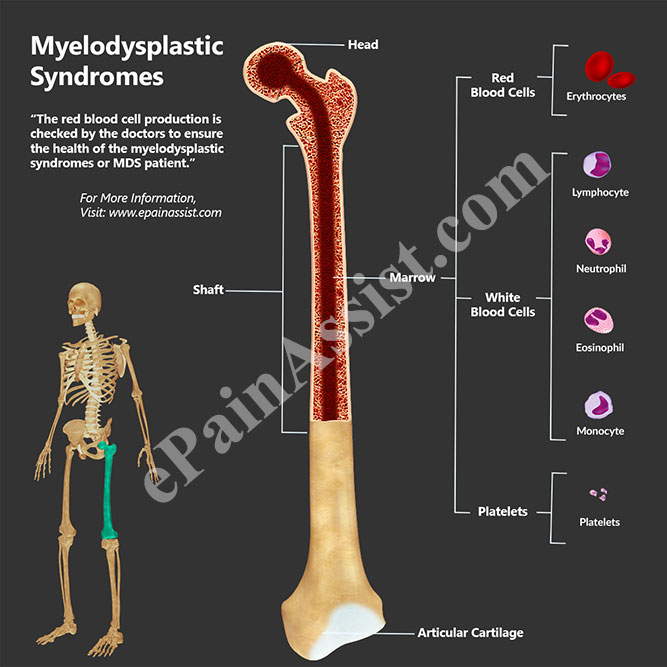 Myelodysplastic Syndromes or MDS