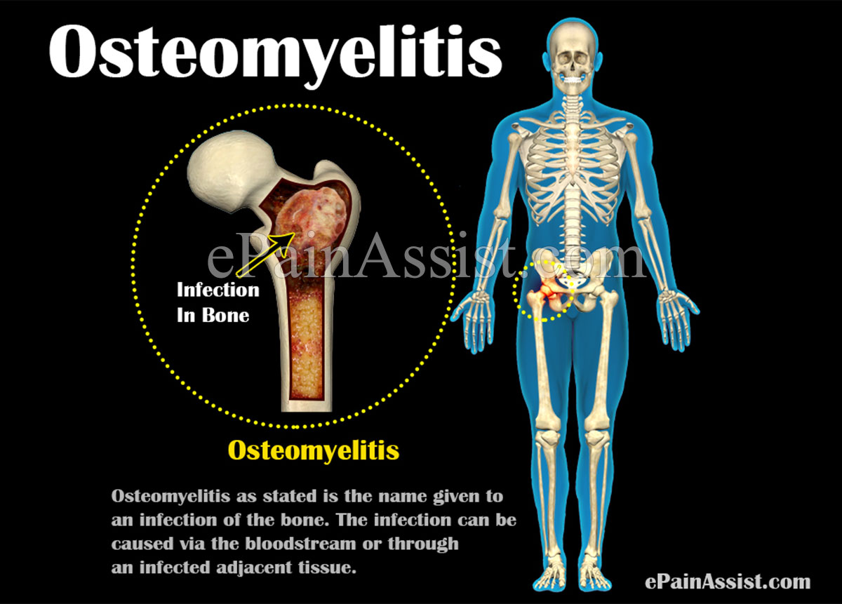 Osteomyelitis: Causes, Risk Factors, Symptoms, Diagnosis, Treatment, Prevention