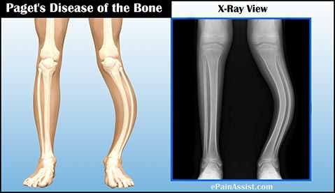 Paget's Disease of the Bone: Causes, Facts, Symptoms, Diagnosis, Treatment, Prognosis 