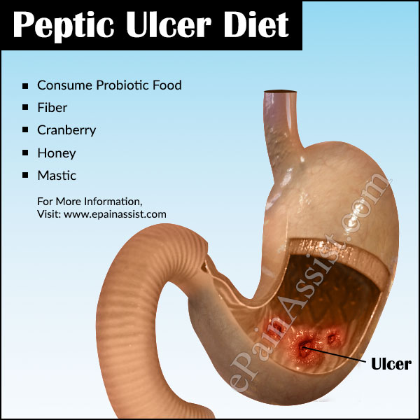 Diet Chart For Peptic Ulcer Patient