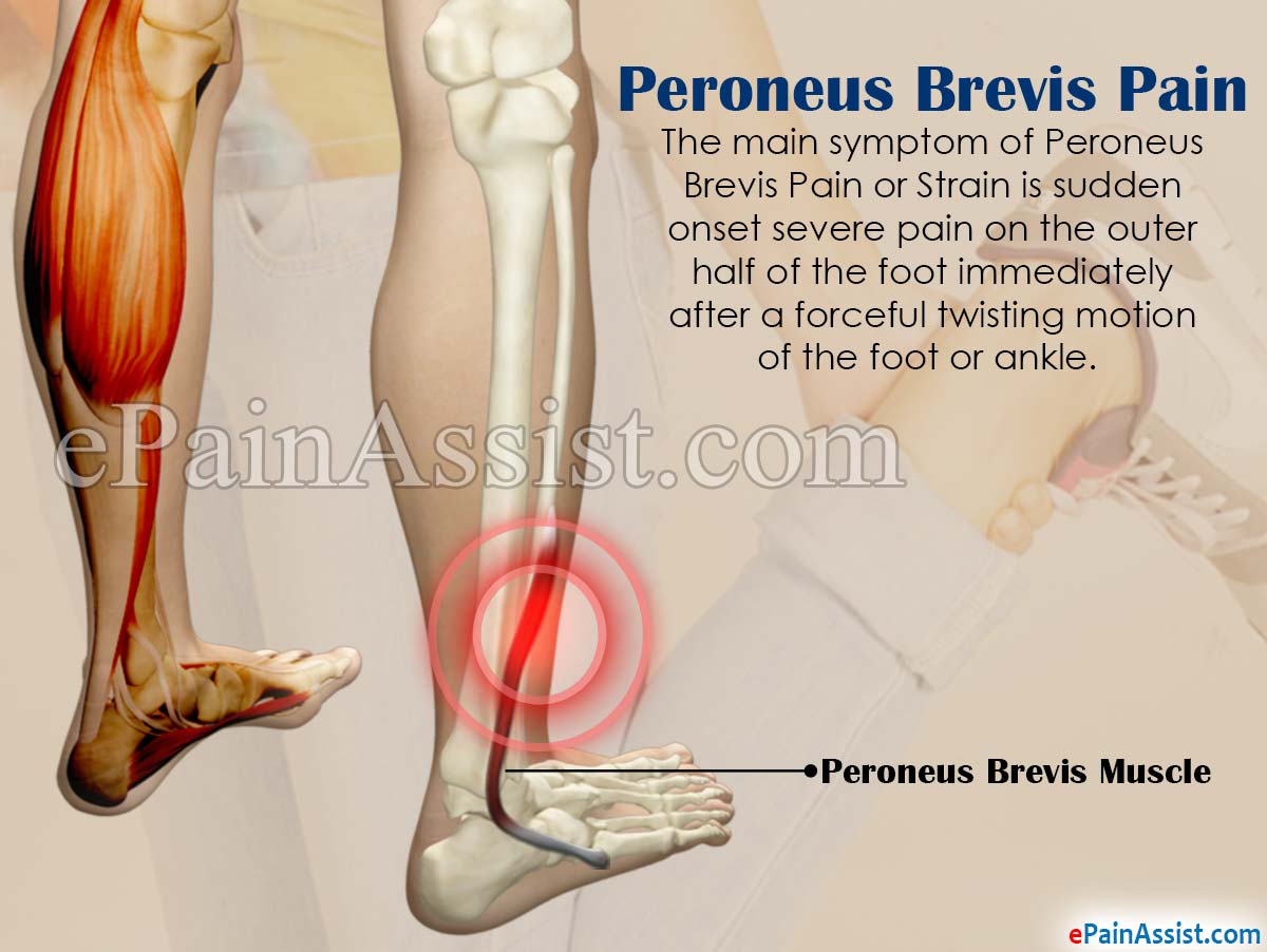 Peroneus Brevis Pain or Strain